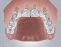 02-camlog-zahnloser-mit-implantatversorgung