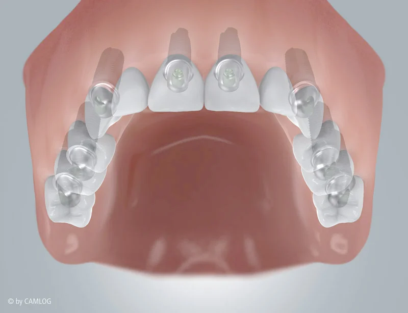 Camlog, Zahnloser mit Implantatversorgung