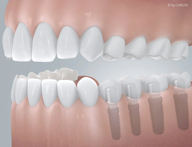 Camlog, Freiendluecke mit Implantatversorgung