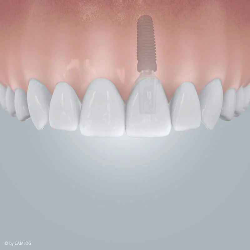 Camlog, Einzelzahnluecke mit Implantatversorgung