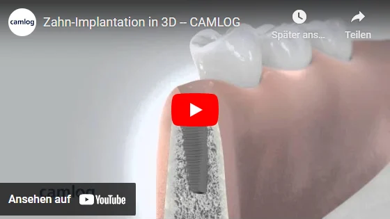 Video, Camlog, Zahn Implantation in 3D